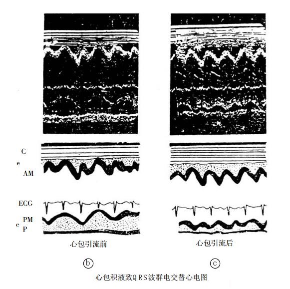 心包积液致QRS波群电交替心电图表现
