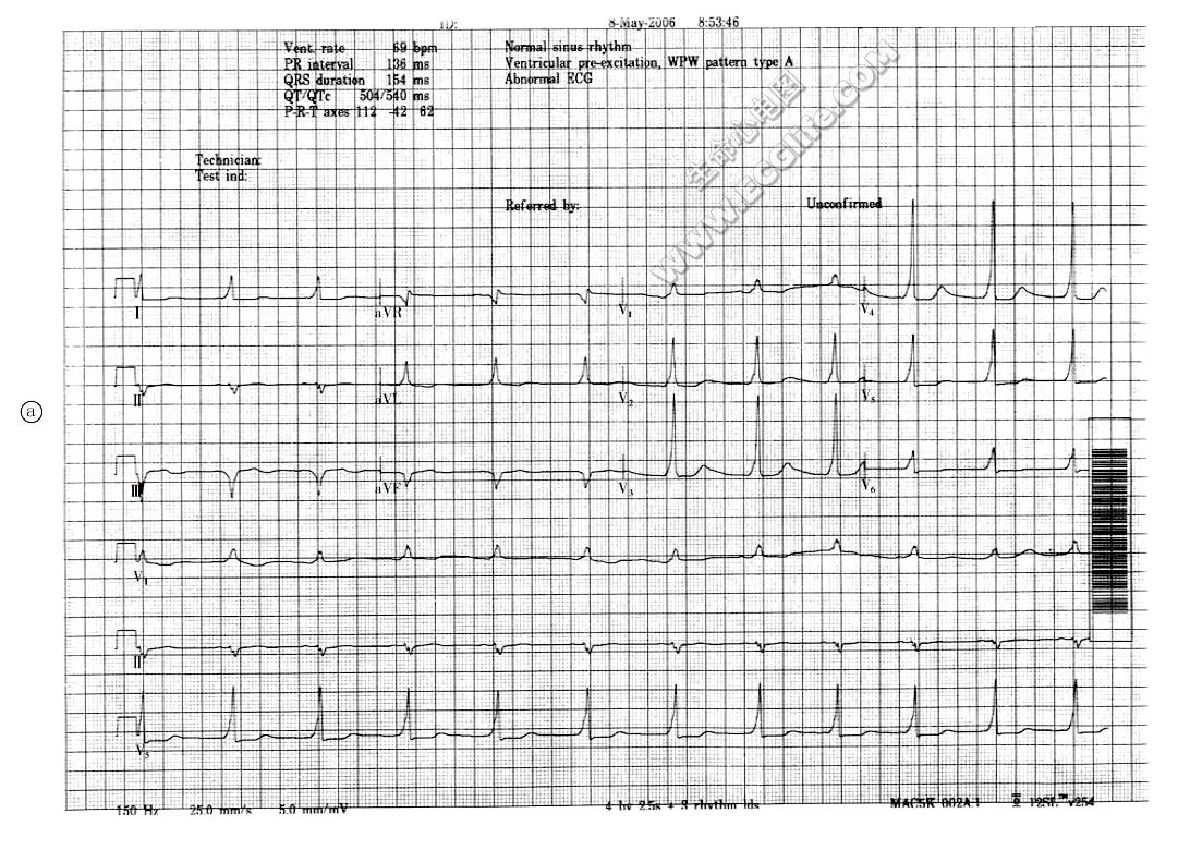 A型预激综合征诊断心电图