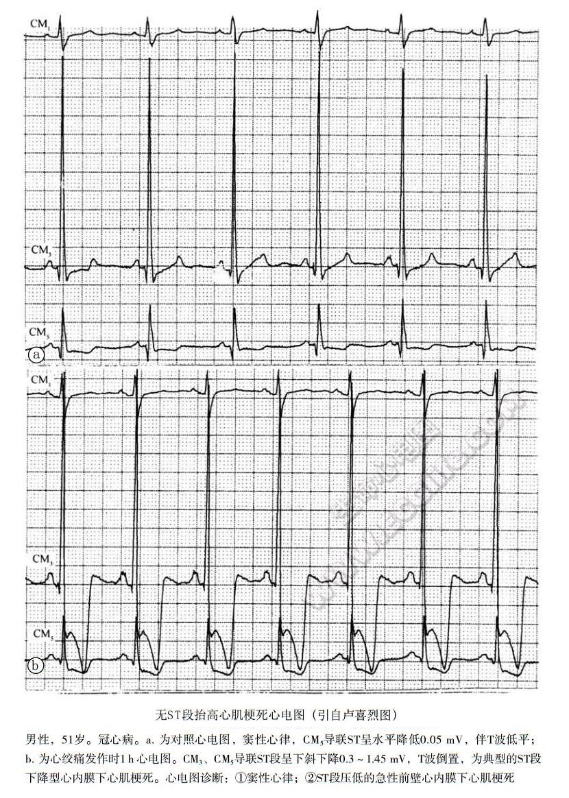 急性冠脉综合征：无ST段抬高心肌梗死心电图