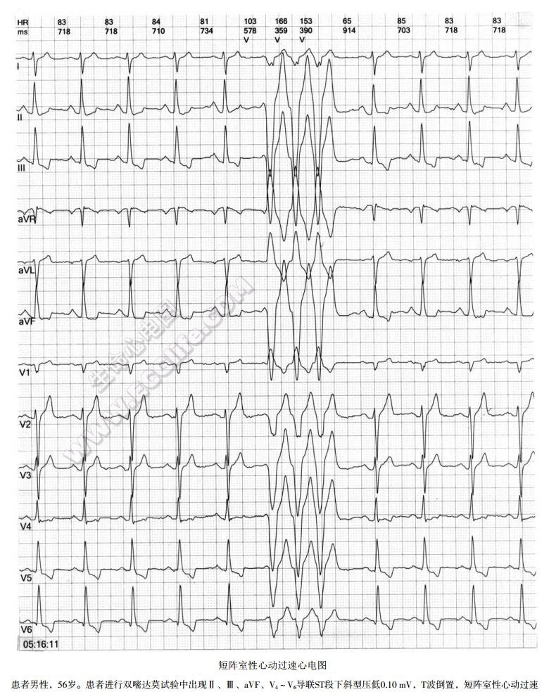 短阵室性心动过速心电图