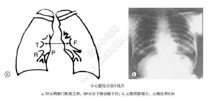 小心脏综合征胸部X线片