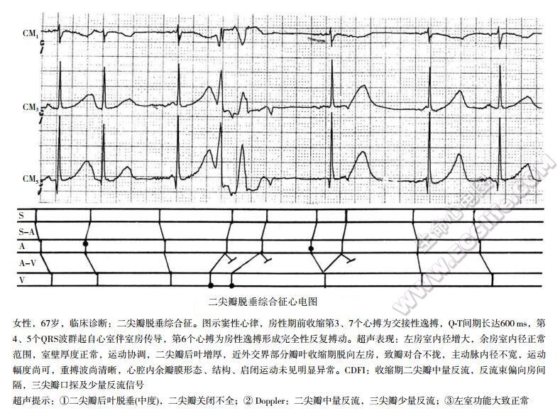 二尖瓣脱垂综合征（Barlow综合征）