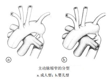 主动脉缩窄的分型