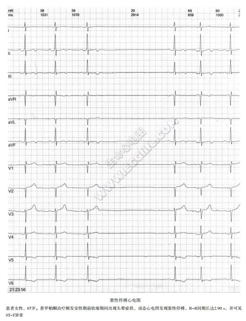 窦性停搏心电图
