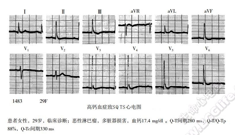 高钙血症致SQTS心电图