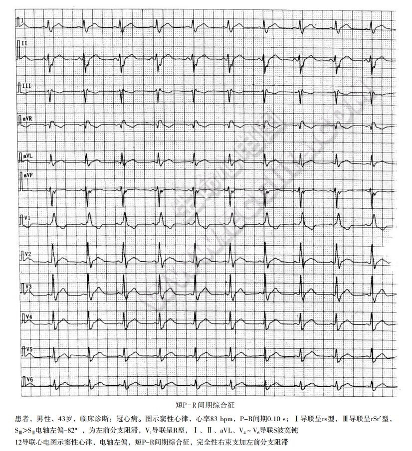 短PR间期综合征心电图表现