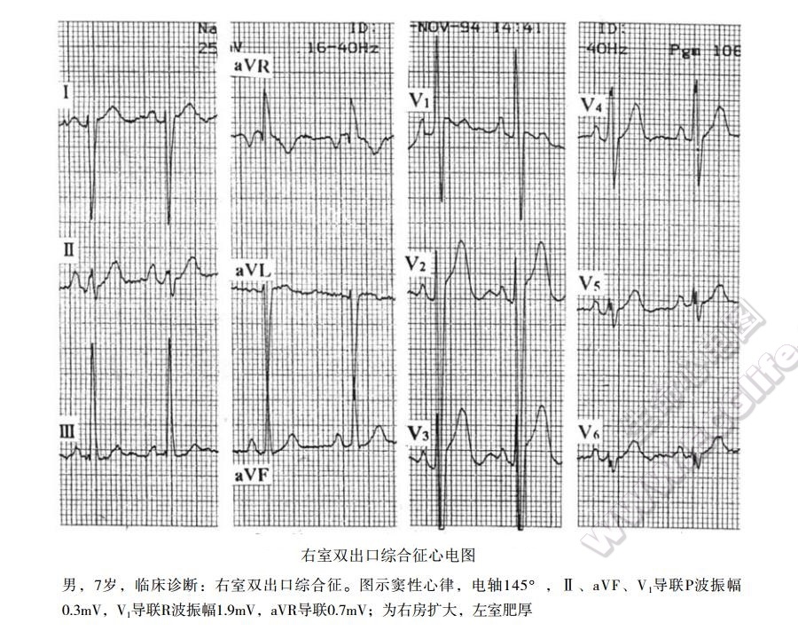 右室双出口心电图表现