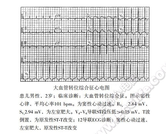 完全性大血管转位（大动脉转位、大动脉错位）