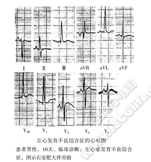 左心发育不全综合征心电图表现