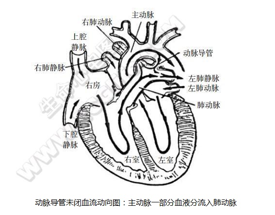 动脉导管未闭心脏血流动向示意图（主动脉一部分血流分流入肺动脉）