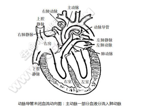 动脉导管未闭解剖图图片