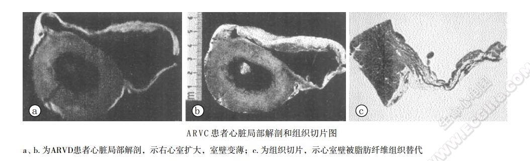 ARVC患者心脏局部解剖和组织切片图