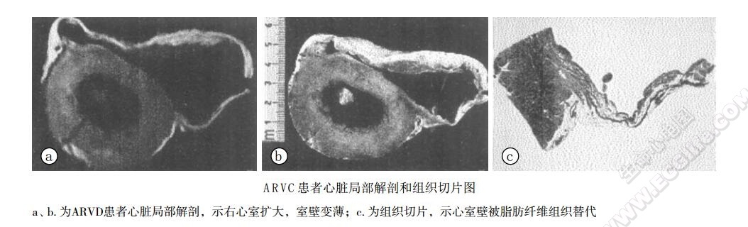 Uhl综合征（先天性右心室心肌萎缩、羊皮纸样右心室）