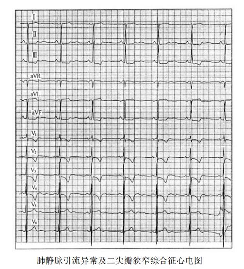 肺静脉畸形引流伴二尖瓣狭窄综合征心电图表现