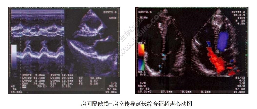 房间隔缺损-房室传导延长综合征超声心动图