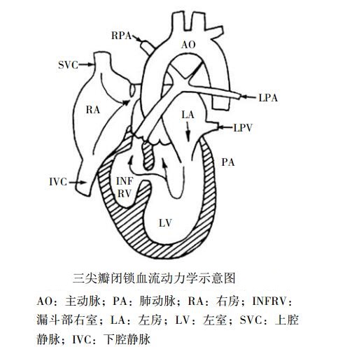 三尖瓣闭锁血流动力学示意图