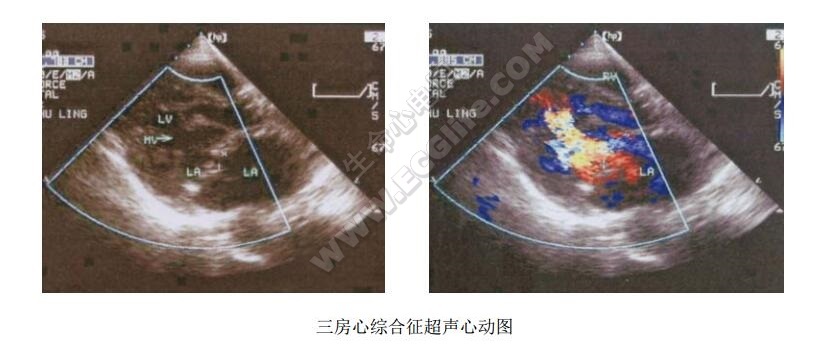 三房心超声心动图检查