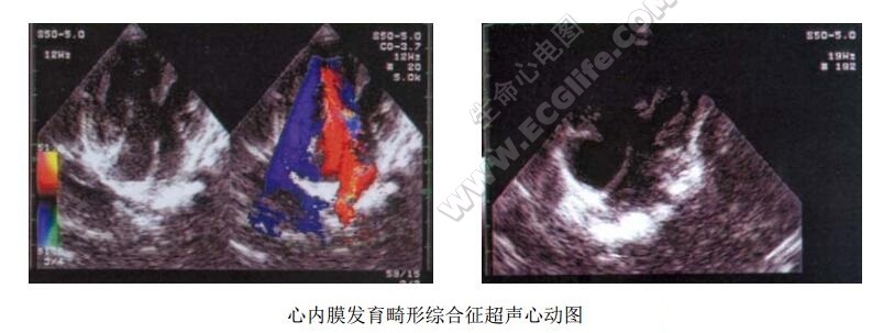 心内膜垫发育畸形综合征（房室间隔缺损、房室共同开口综合征）超声心动图