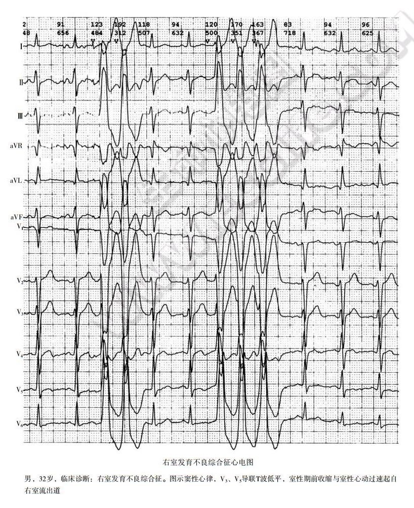 致心律失常性右室心肌病（右室发育不良综合征、ARVC）心电图表现