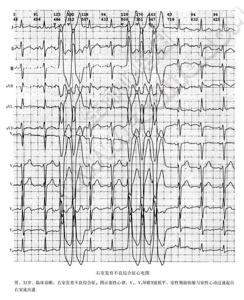 致心律失常性右室心肌病（右室发育不良、ARVC）
