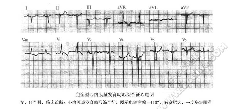 心内膜垫发育畸形综合征（房室间隔缺损、房室共同开口综合征）心电图表现