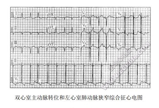 双心室主动脉转位和左心室肺动脉狭窄综合征心电图表现