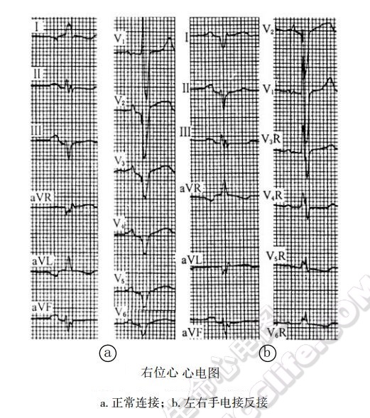 真性右位心心电图表现