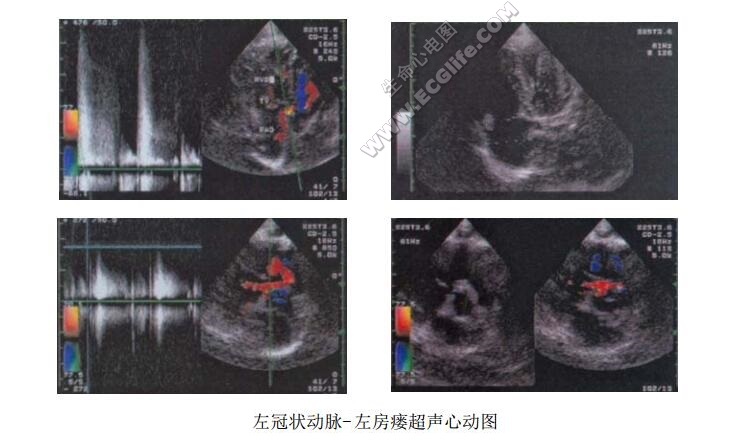 左冠状动脉-左房瘘超声心动图