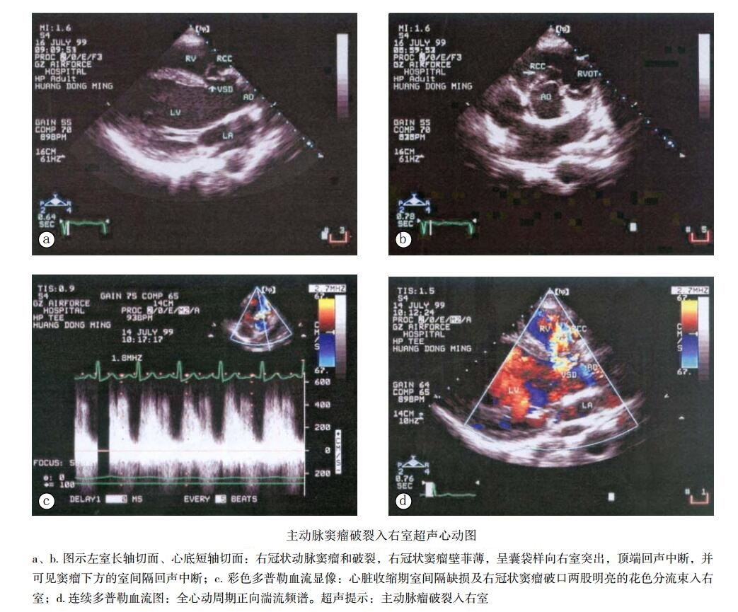 先天性主动脉窦动脉瘤破裂入右心室超声心动图