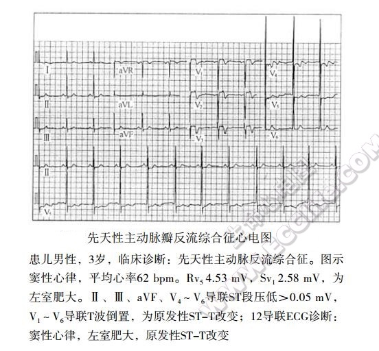 先天性主动脉瓣反流综合征（先天性主动脉瓣关闭不全）心电图表现