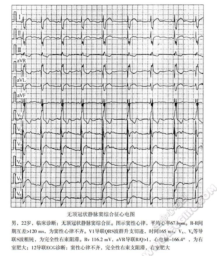 无顶冠状静脉窦综合征（冠状静脉窦间隔缺损）