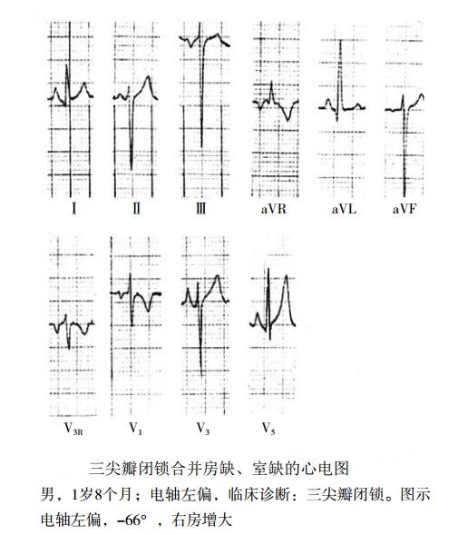 三尖瓣闭锁心电图