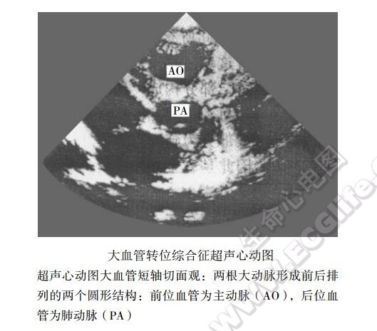 完全性大血管转位超声心动图