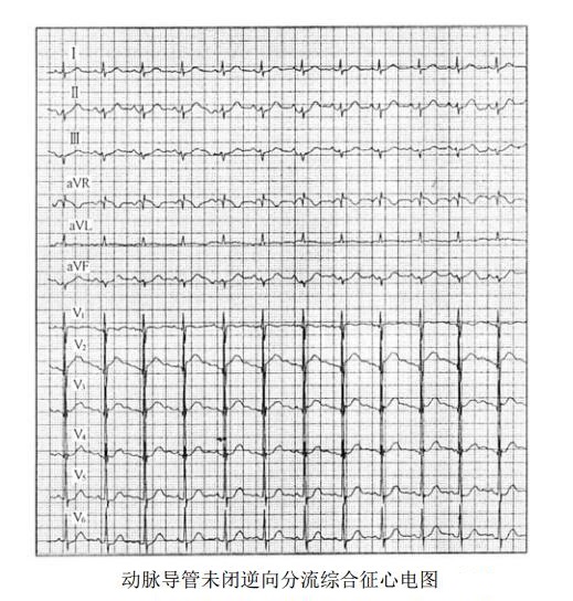 动脉导管未闭逆向分流综合征患者心电图表现