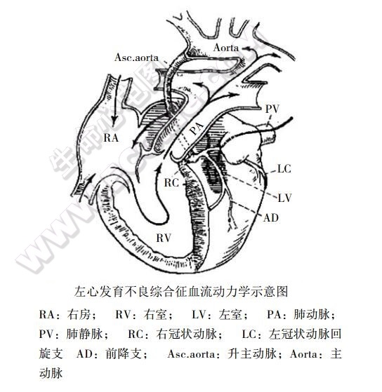 左心发育不全综合征