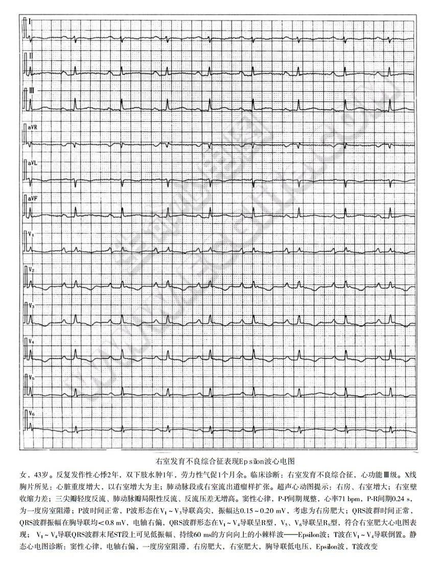 致心律失常性右室心肌病表现epsibn波心电图