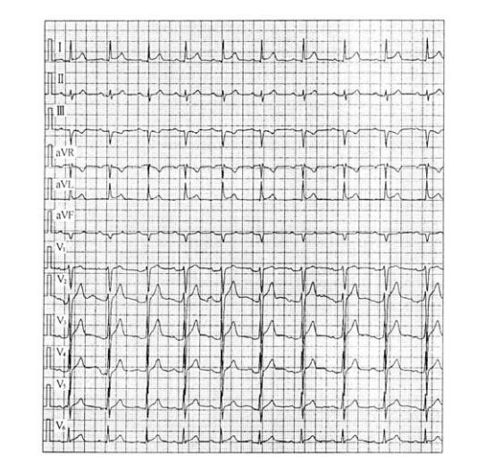 房间隔缺损-房室传导延长综合征心电图表现