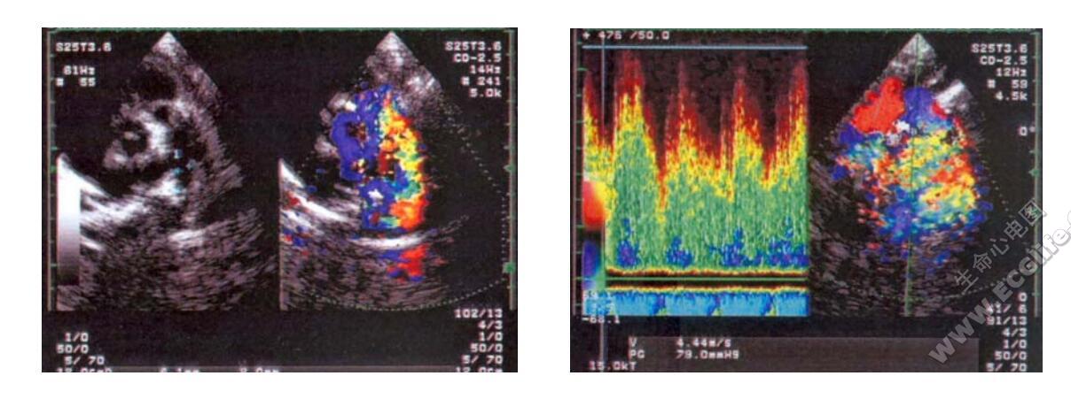 动脉导管未闭超声心动图