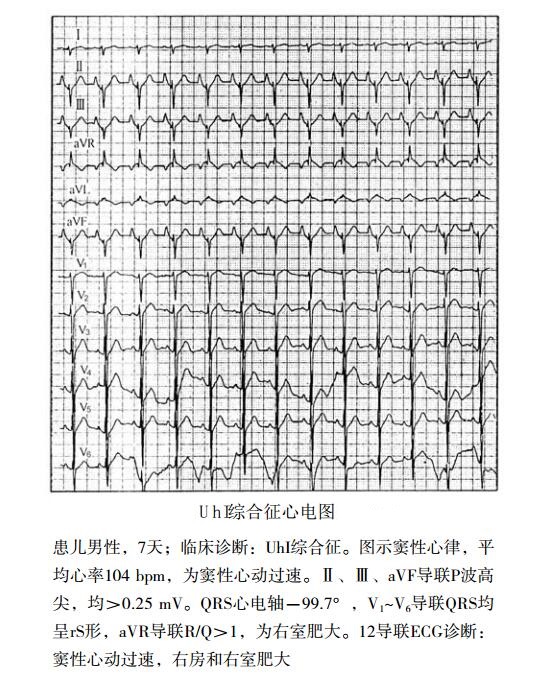 Uhl综合征（先天性右心室心肌萎缩、羊皮纸样右心室）心电图表现