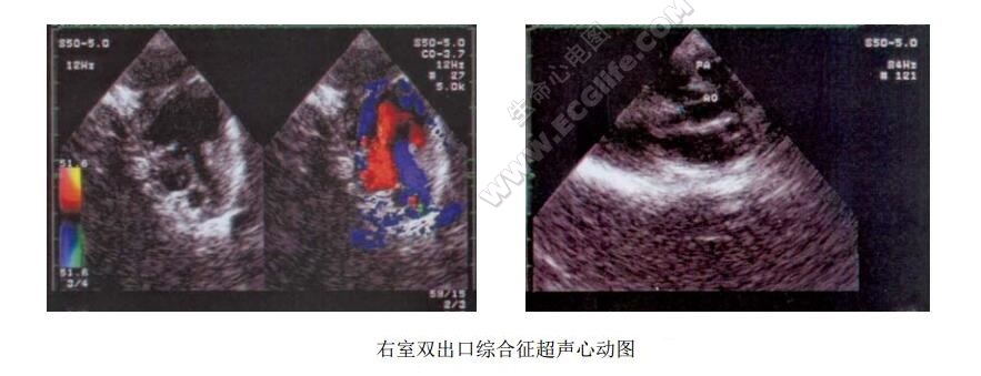 右室双出口超声心动图
