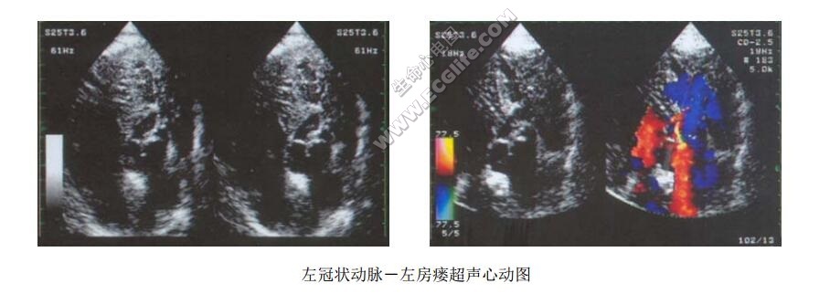 左冠状动脉畸形综合征（先天性冠状动脉瘘）超声心动图