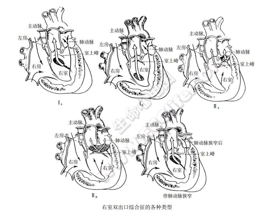 右室双出口的分型