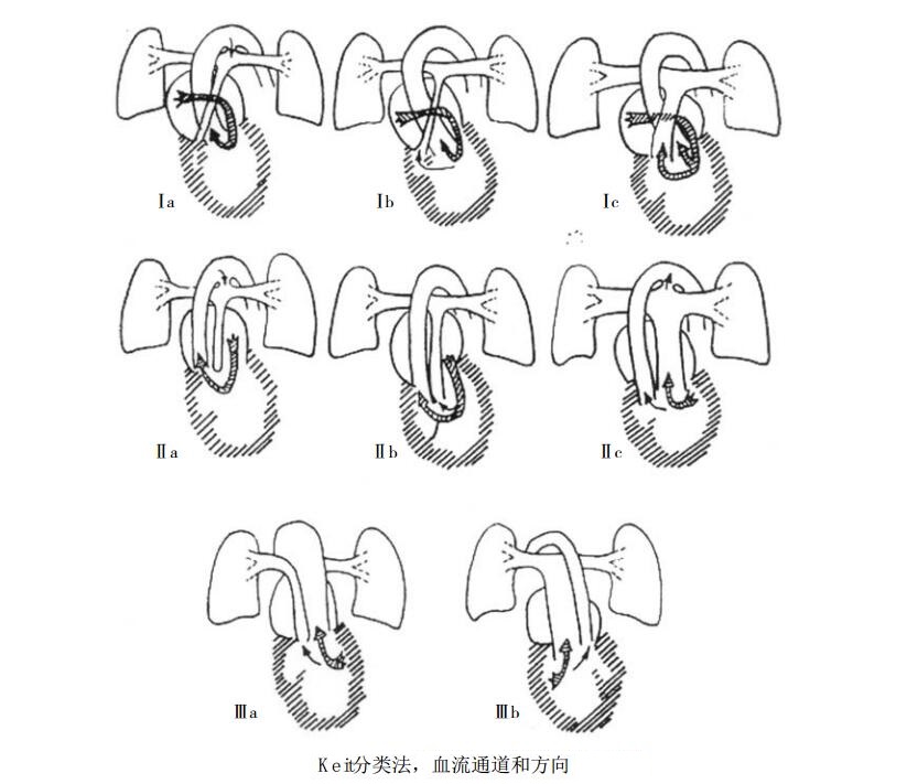 三尖瓣闭锁的分型，血流通道和方向
