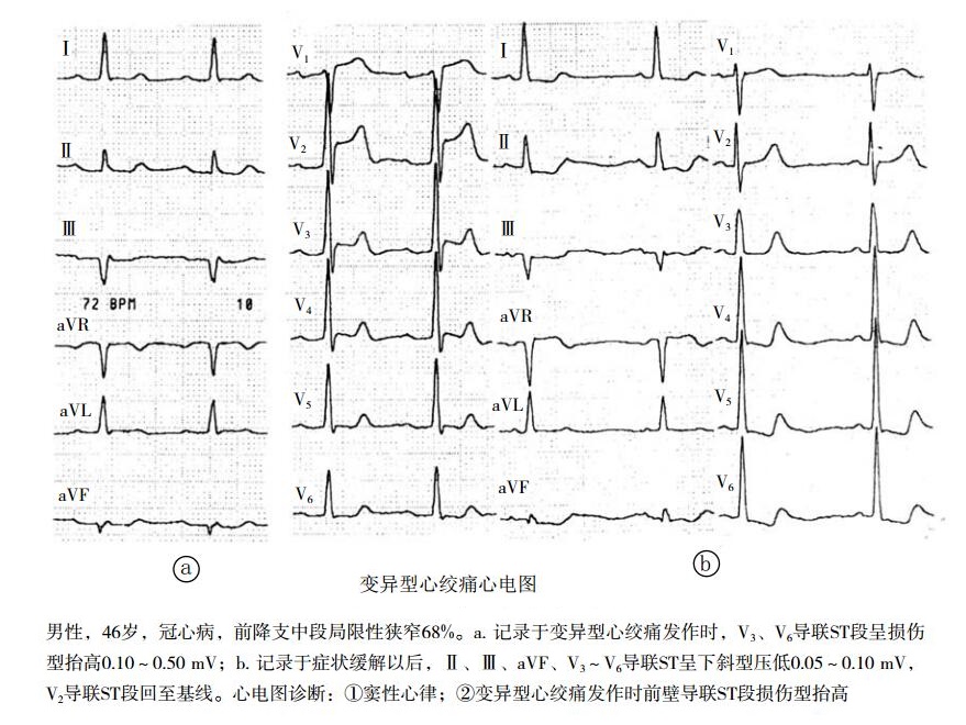 变异型心绞痛心电图