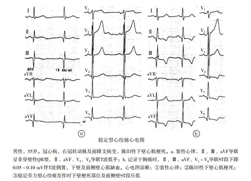 稳定型心绞痛心电图