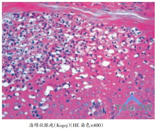 脓疱及Kogoj海绵状脓疱
