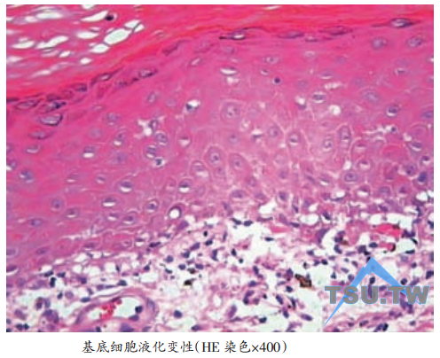 基底细胞液化变性