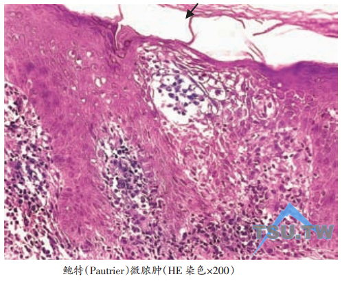 鲍特( Pautrier)微脓肿