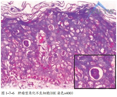 肿瘤型角化不良也称个别细胞角化不良