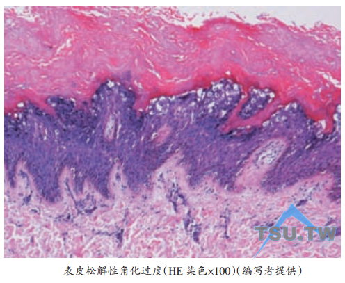 表皮松解性角化过度